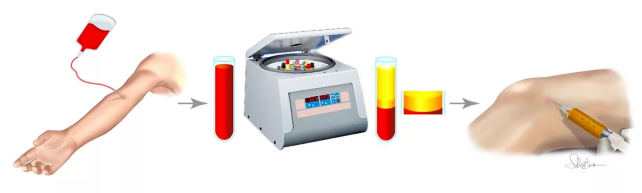 Плазмолифтинг суставов (PRP-терапия)