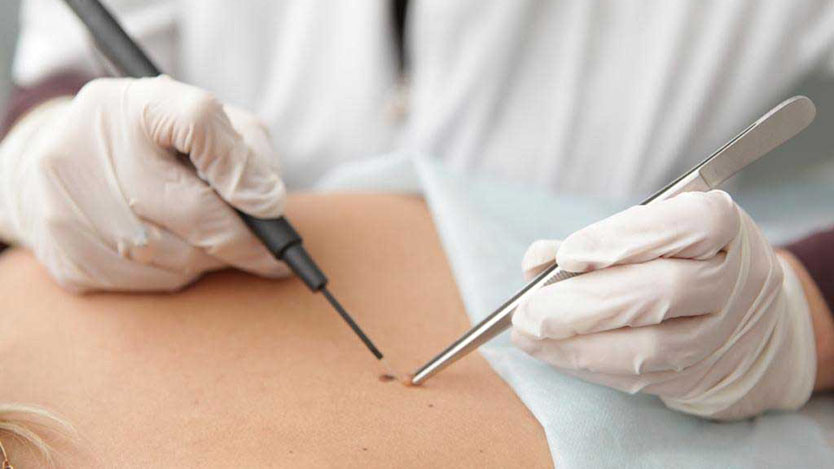 Удаление папиллом и доброкачественных новообразований кожи
